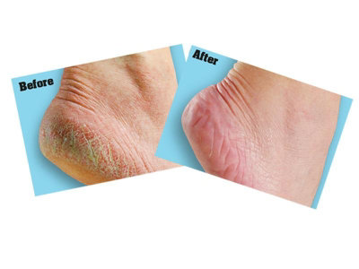 Gorilla Glue 8144001 O'Keeffe's Healthy Feet Foot Cream 85g Tube GRGOKHF85G - 3